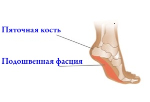 подошвенный фасциит лечение в домашних условиях