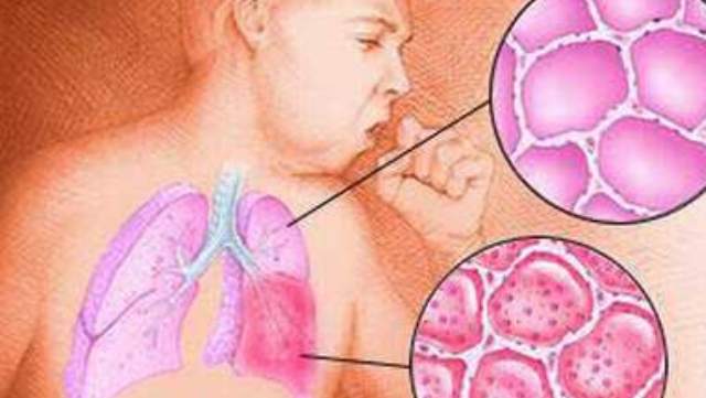 симптомы мокроты