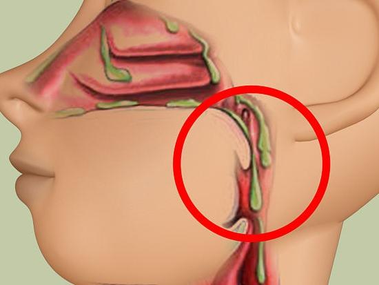 образование бронхита